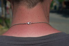 Sonnenbrand